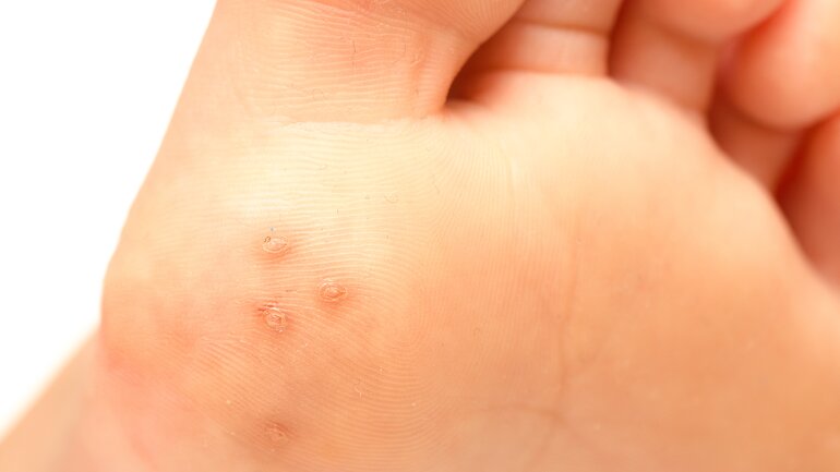 Humanes Papillomvirus löst Mosaikwarzen aus