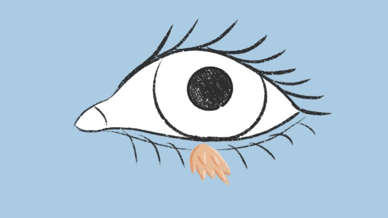 Warzenarten: Pinselwarze häufig am Auge