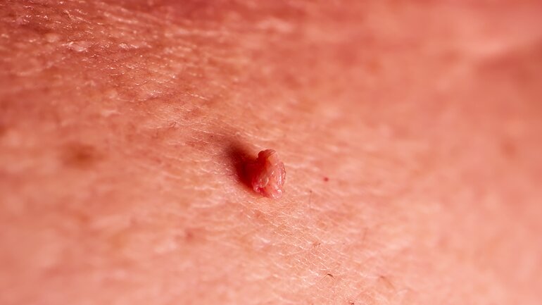 Warzenarten: Stielwarze oder weiches Fibrom