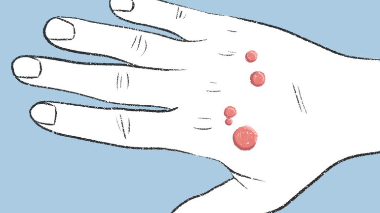Flachwarzen: Warzenart häufig bei Kindern