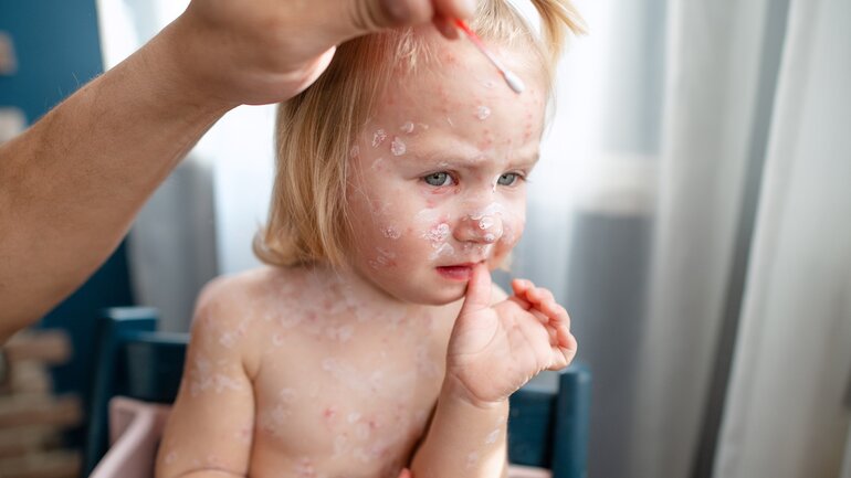 Windpocken-Narben vermeiden