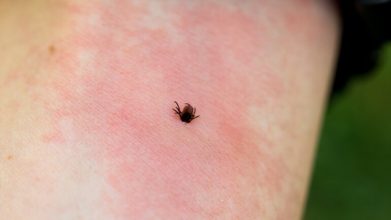 Borreliose auch ohne Wanderröte möglich
