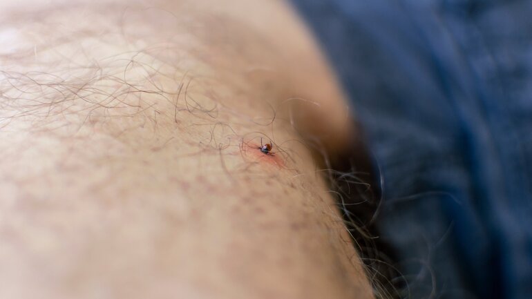 Zeckenbiss: Bild am Bein