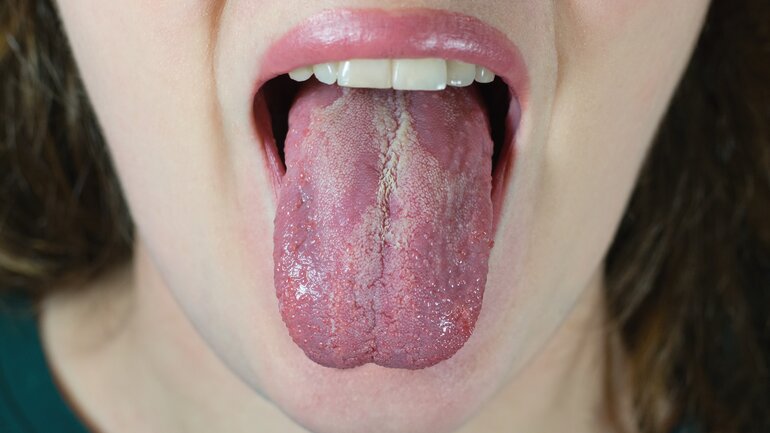Belegte Zunge: Symptom bei Zungenkrebs?