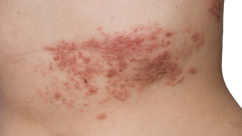 Gürtelrose (Herpes Zoster)