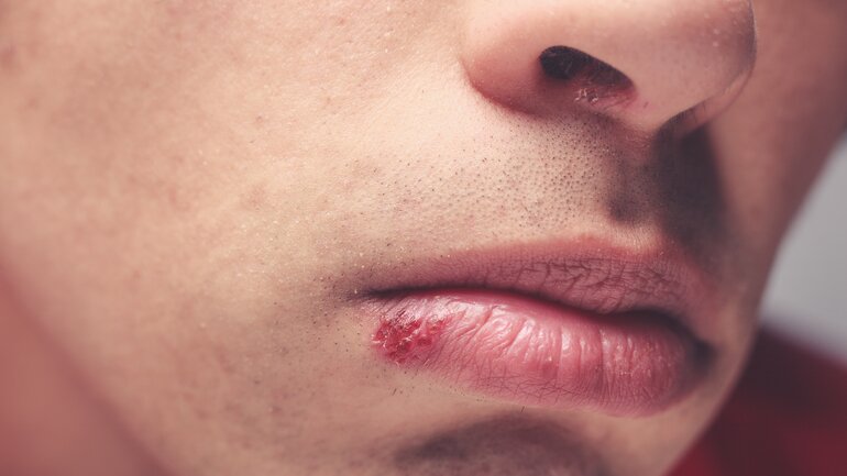 Herpes-Bläschen an der Lippe