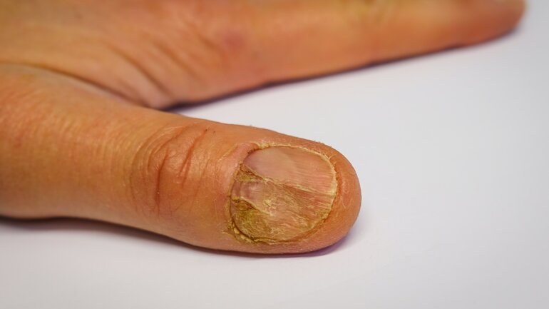 Nagelpsoriasis