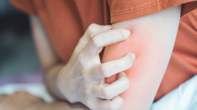 Frau mit Neurodermitis kratzt sich am Arm