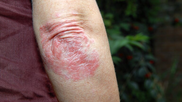Psoriasis: Ursachen und Symptome