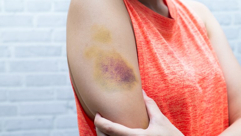 purpura