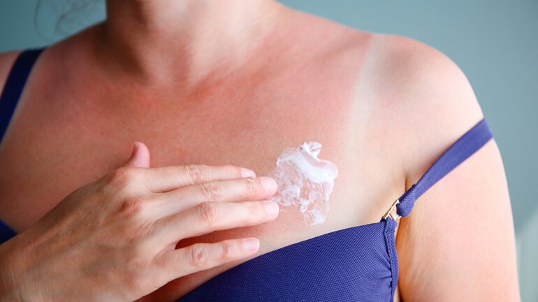 Frau mit Sonnenbrand