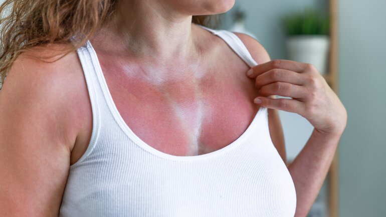 homöopathie sonnenbrand.jpg